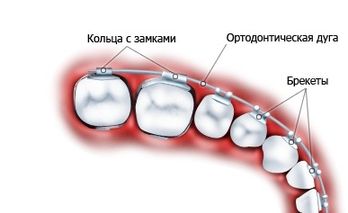 Во сне вырывать зубы. Сонник. Значение Бородавки папилломы родинки удаление ВКонтакте