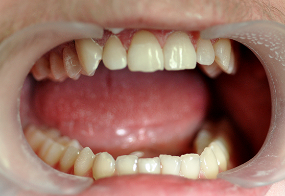 Флюороз зубов: причины, фото и лечение, флюороз у детей