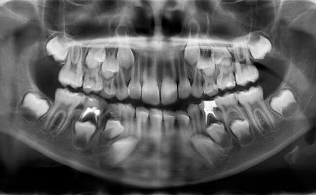 Фото рентгена молочных зубов ребенка