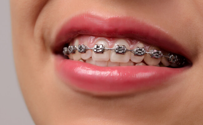 Фото металлических брекетов на зубах