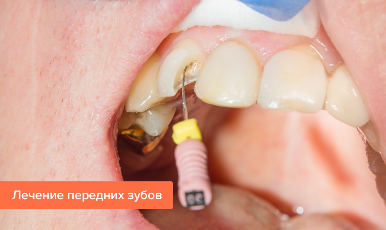 Фото лечения передних зубов