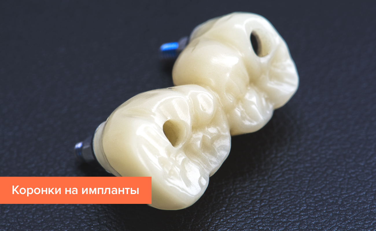 Из каких материалов ставят коронки для зубов Из каких материалов ставят коронки для зубов