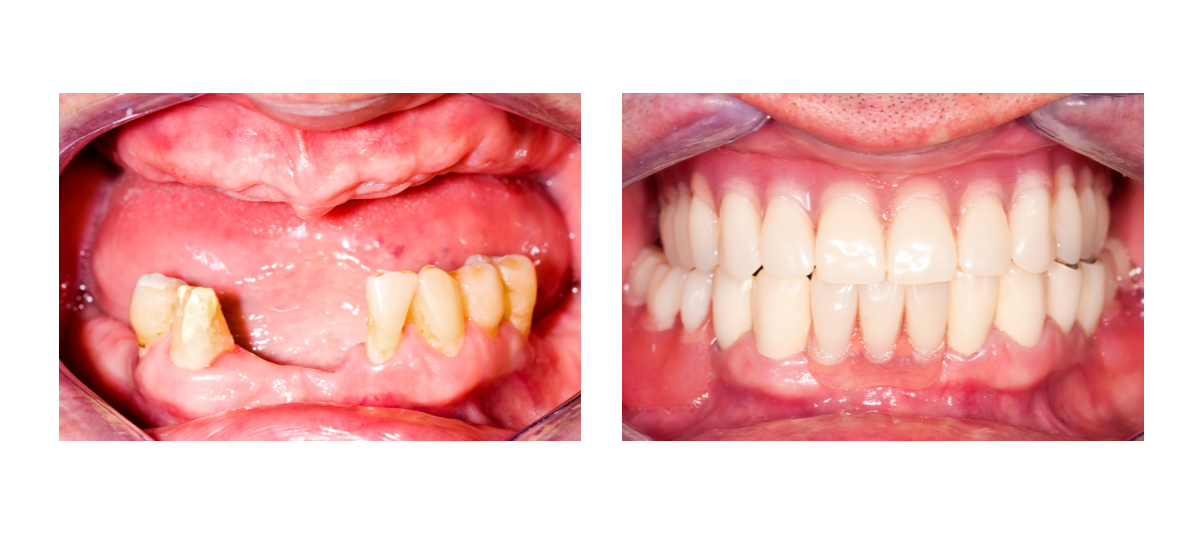 Фото пациента до и после установки протеза Квадротти 