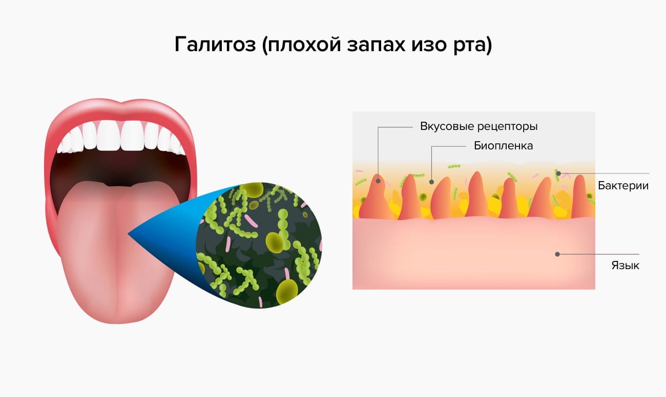 Плохой запах изо рта в картинках