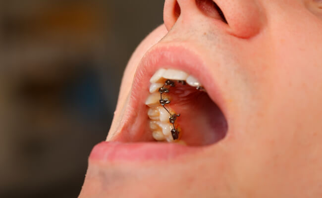 Фото лингвальных брекетов на зубах
