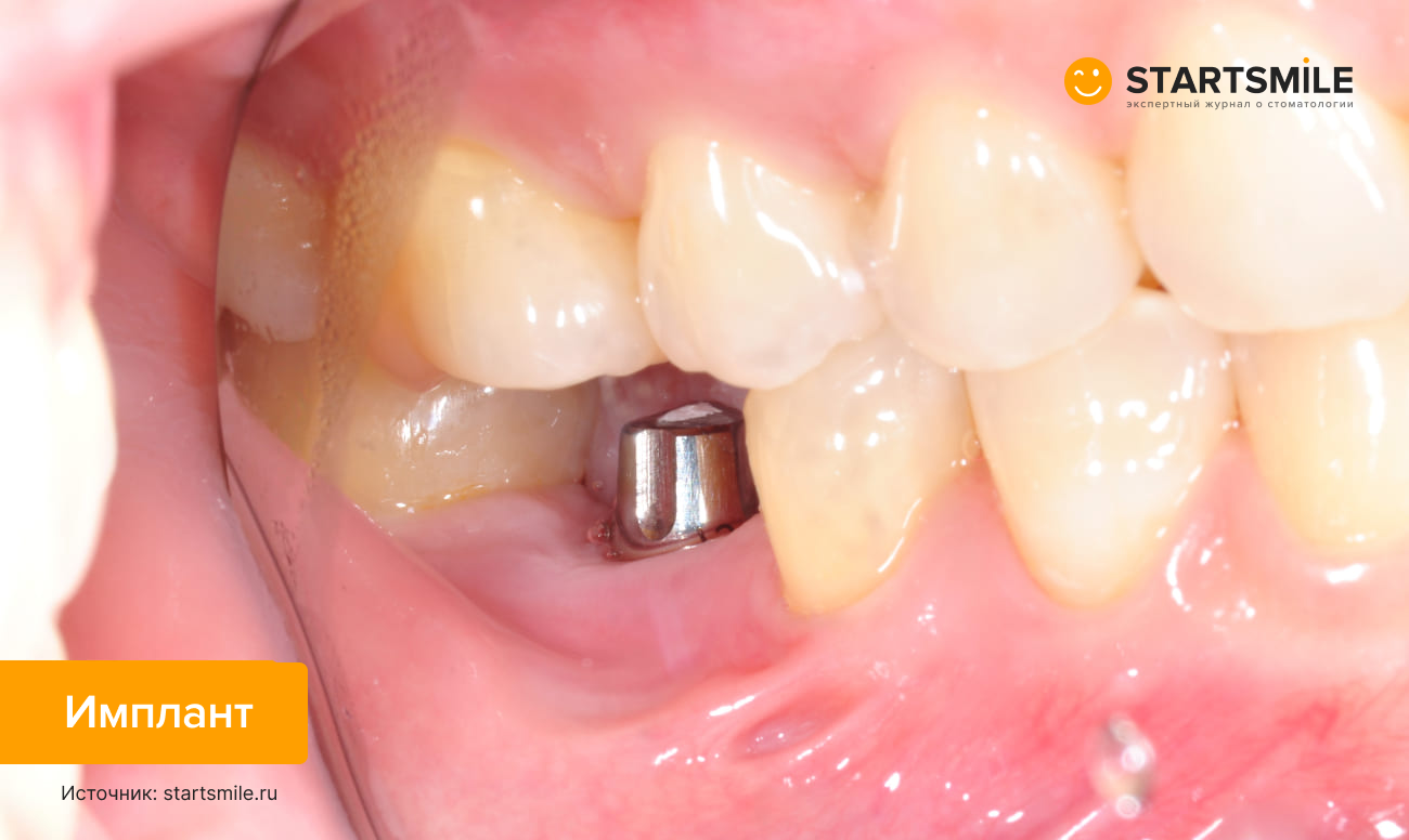 Фото импланта, установленного на место отсутствующего жевательного зуба.