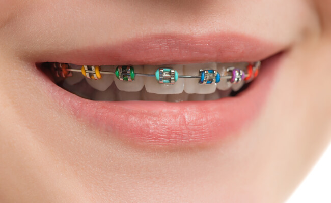 Фото обычных брекетов с лигатурами на зубах