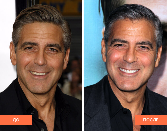 Фото Джорджа Клуни до и после установки виниров