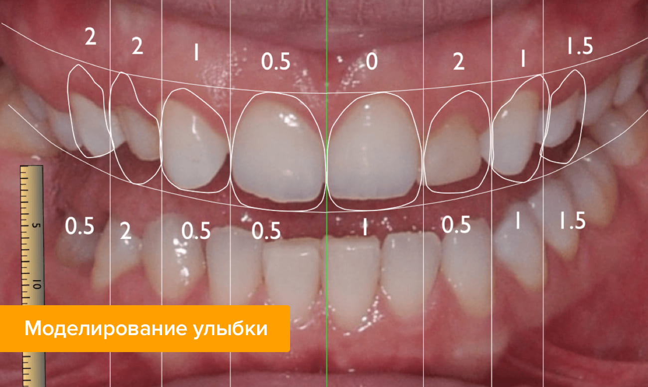 Фото зубов в процессе моделирования улыбки