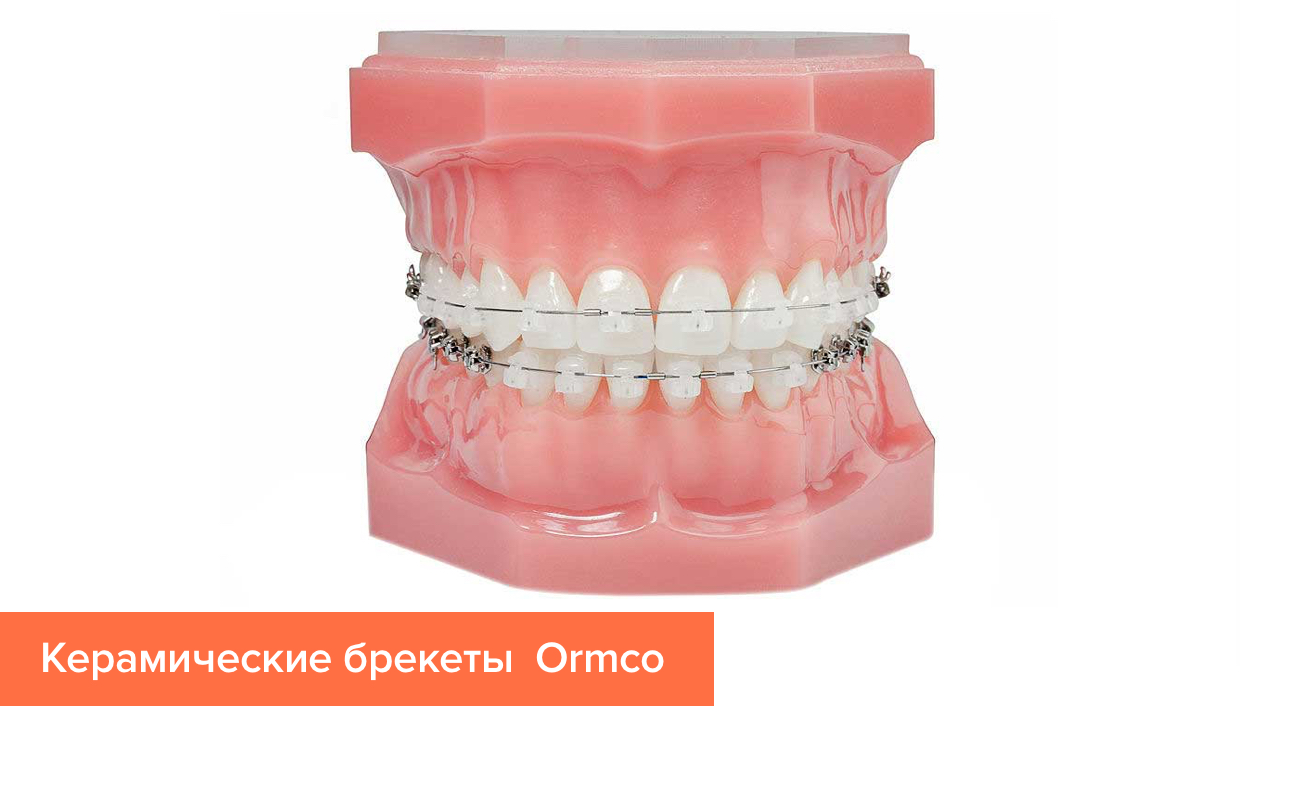 Фото керамических брекетов на зубах от компании Ormco
