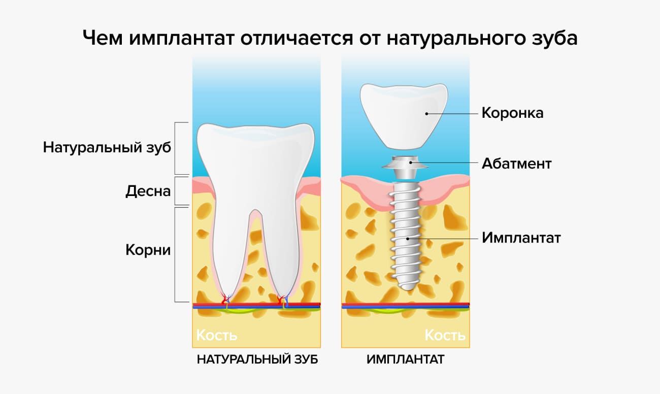 Чем имплант отличается от натурального зуба в картинках