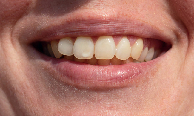 Белые пятна на зубах: причины и как их убрать?