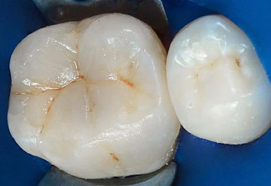 Лечение зубов немецкая клиника