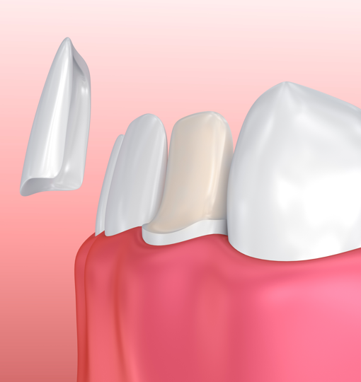 Лечение кариеса стоимость одного зуба в москве thumbnail