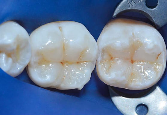 Лечение зубов немецкая клиника