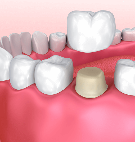 Зубы лечение цены коронки thumbnail