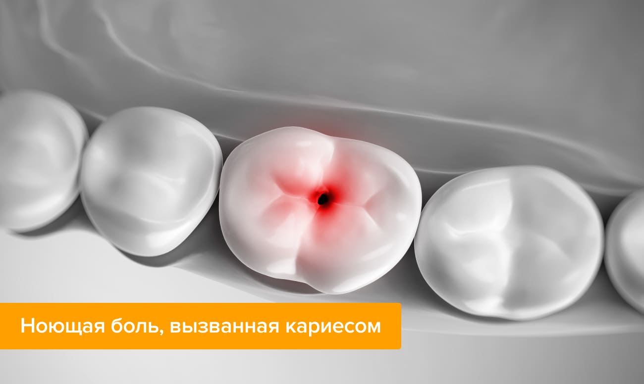 Фото зубов с кариесом, который вызывает ноющую зубную боль