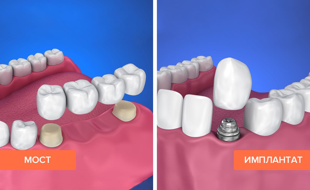 Мост и имплантат на жевательных зубах в картинках