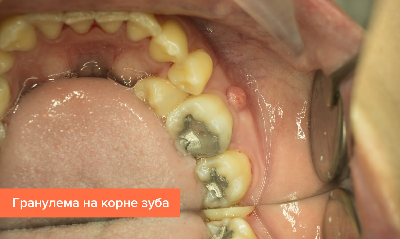 Гранулема корня зуба лечение антибиотиками thumbnail