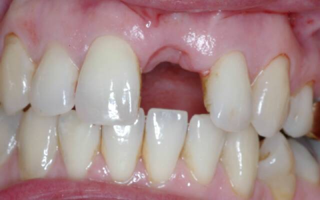 Синдром сухой лунки после удаления зуба как лечить thumbnail