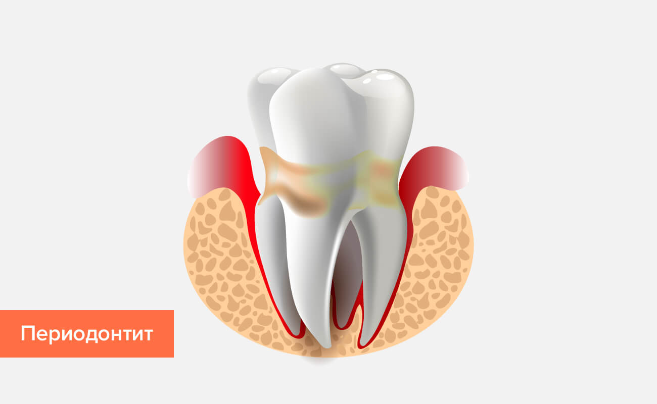 Заболевания зубов и лечение реферат thumbnail
