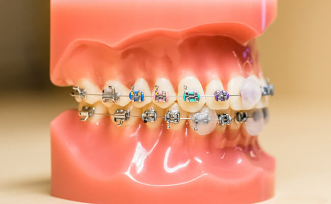 Неправильный рост зубов у детей причины лечение thumbnail
