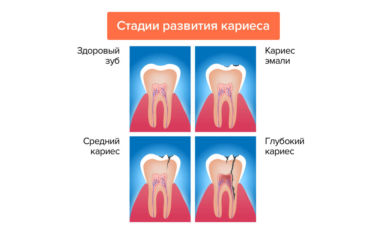 Эндодонтическое лечение при травме зуба thumbnail
