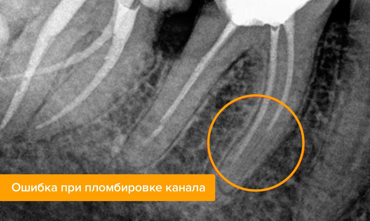 Болит зуб во время удаления нерва thumbnail