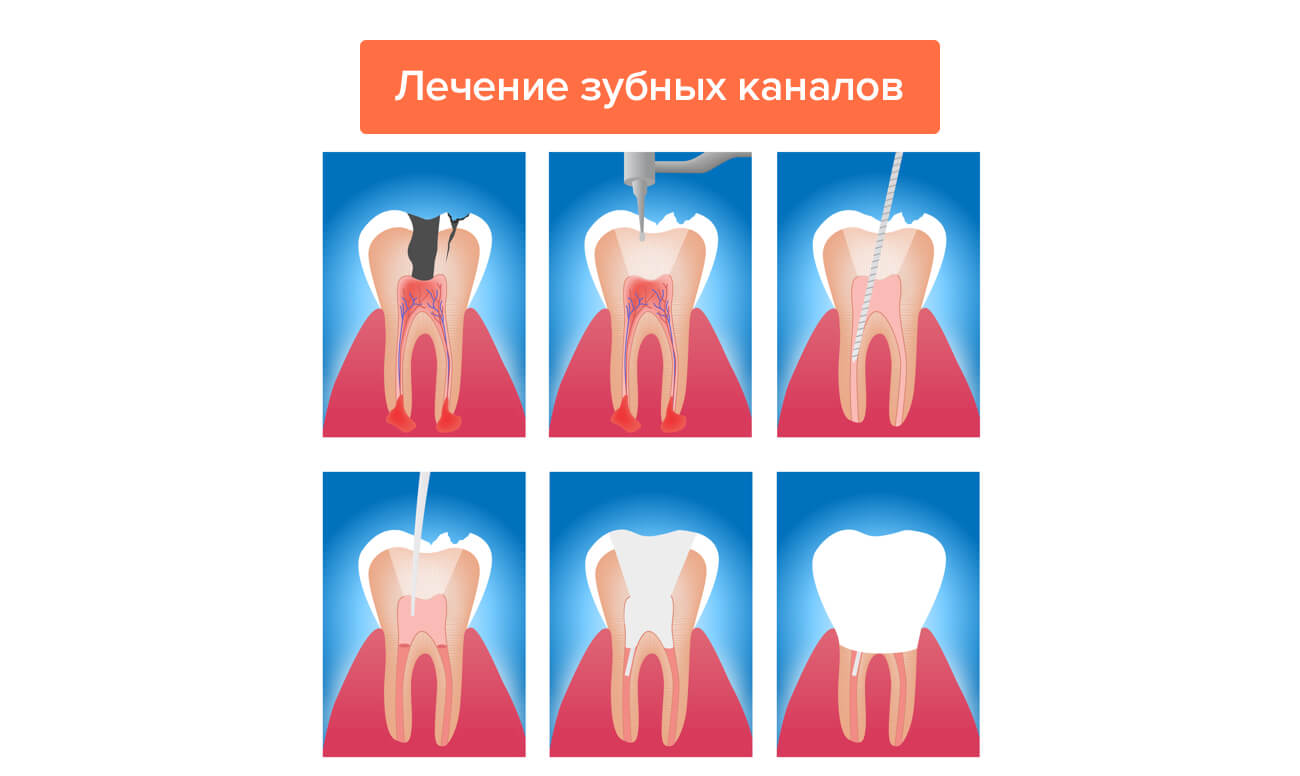 Лечение зубных каналов в картинках