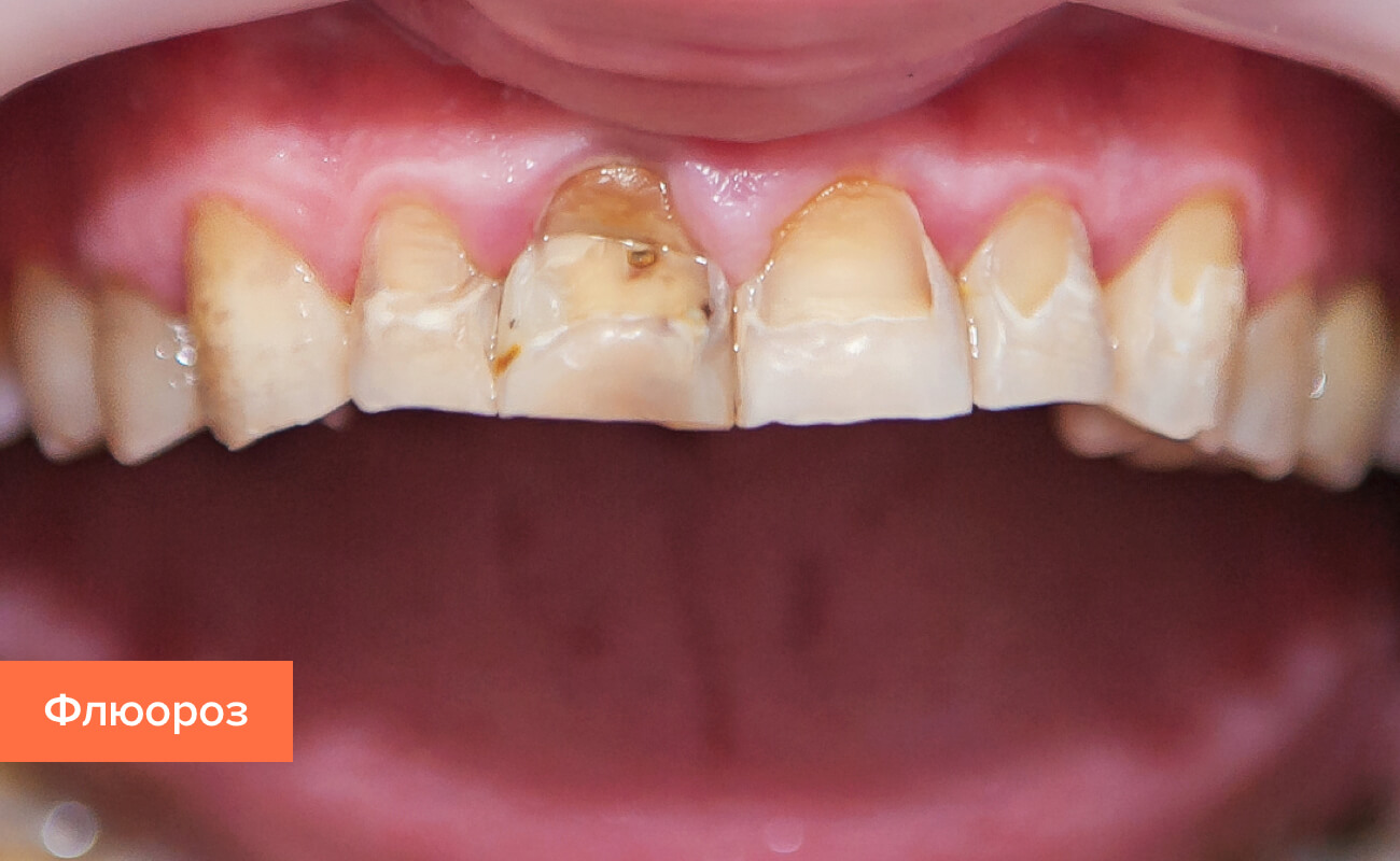 Виды болезней зубов и их лечение thumbnail
