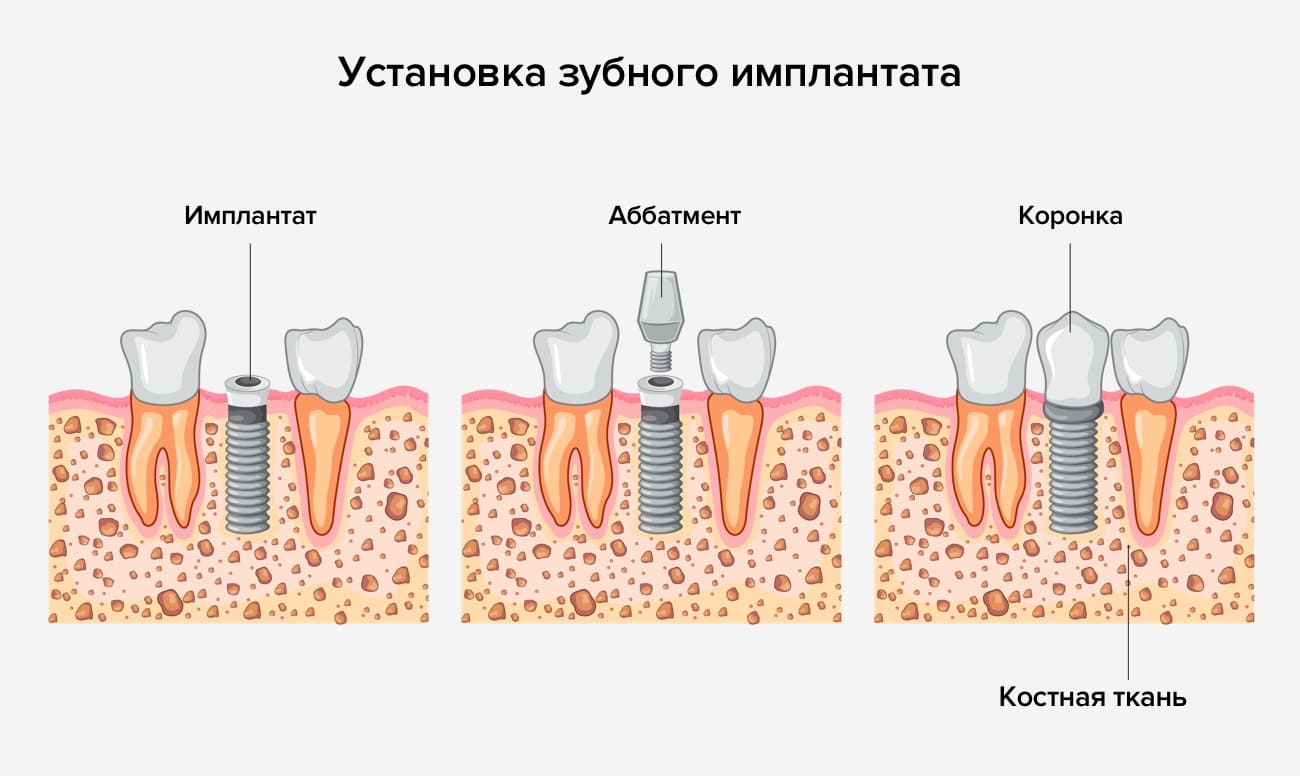 Установка зубного имплантата в картинках