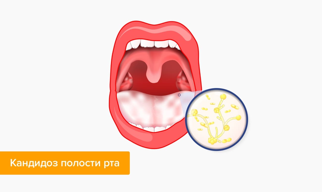 Народное лечение кандидоза во рту thumbnail