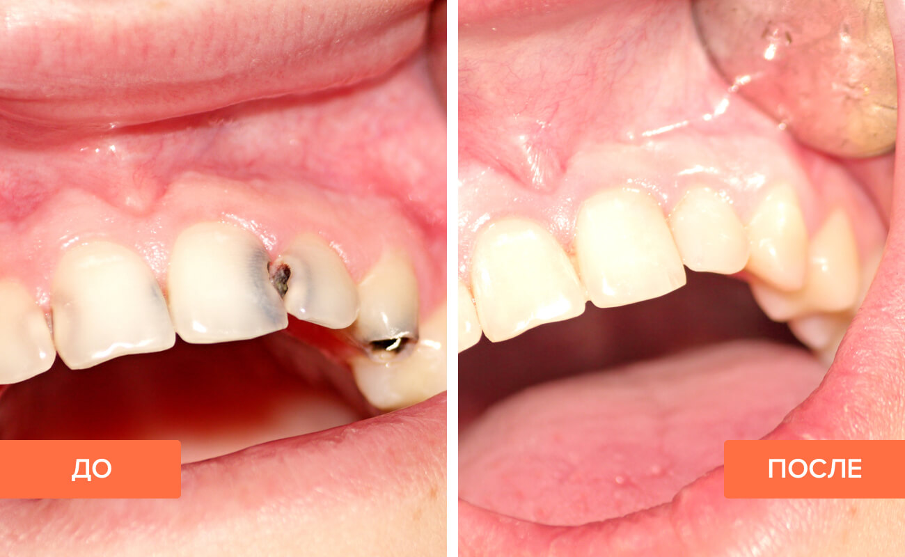 Фото пациента до и после лечения кариеса на передних зубах