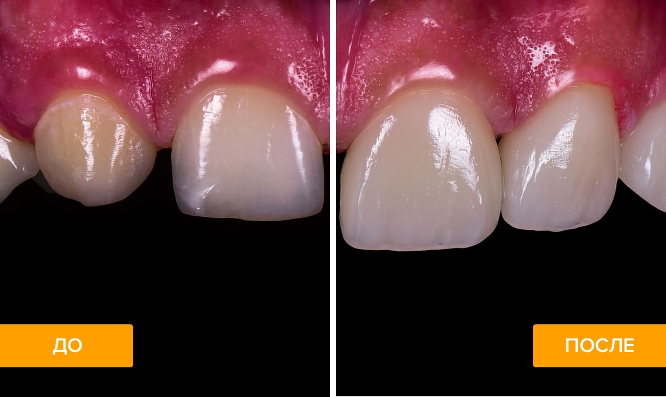 Фото пациента до и после наращивания зубов