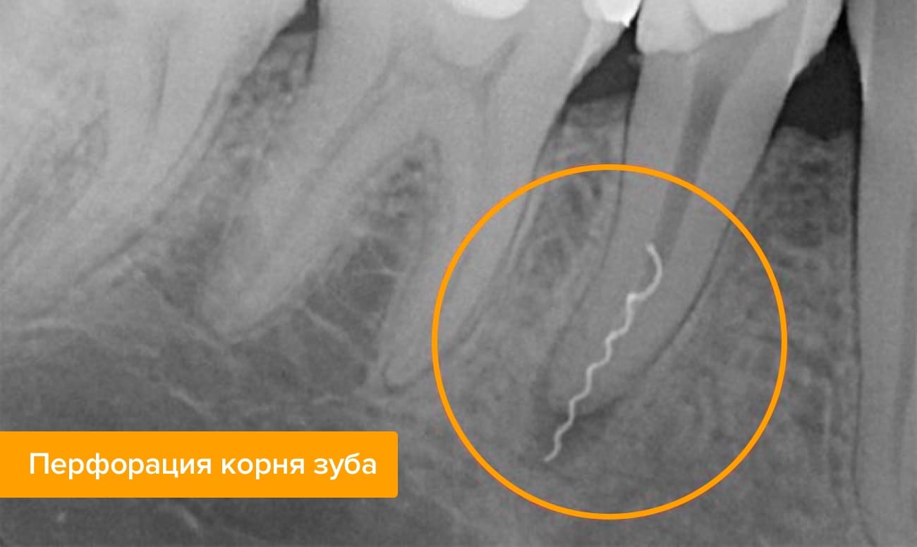 Болит зуб после лечения удаляли нерв thumbnail