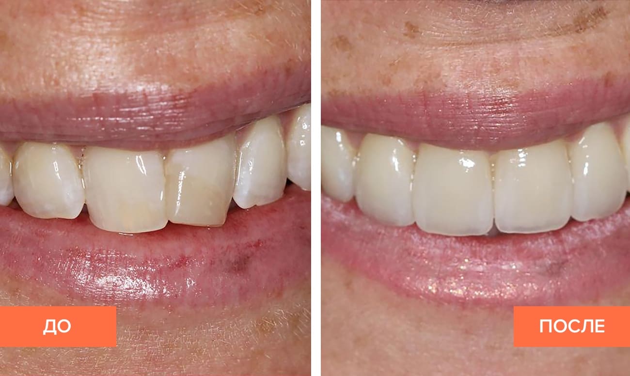 До и после установки коронок на передние зубы