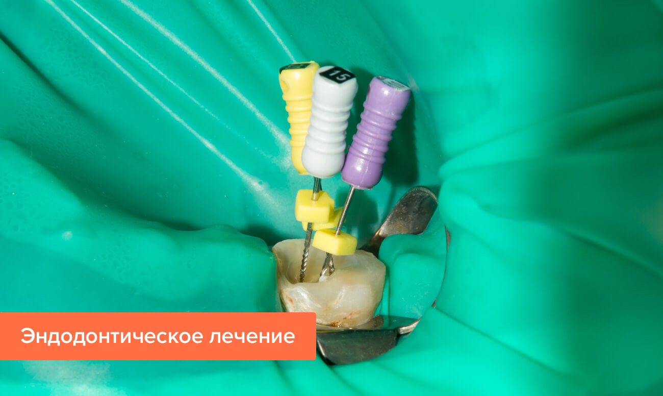 Эндодонтическое лечение трехкорневого зуба с пломбой thumbnail