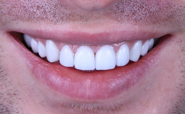 Фото фарфоровых коронок на зубах