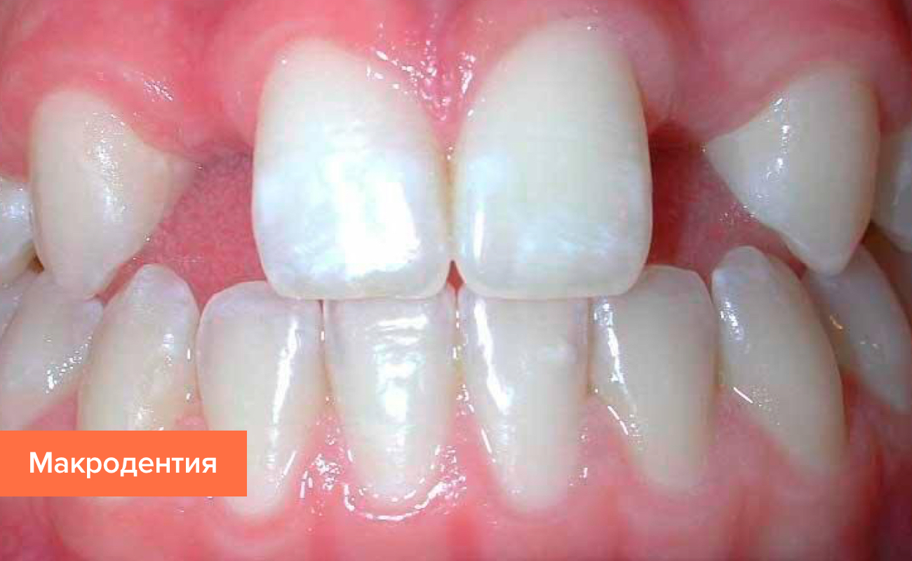 Лечение зубов виды заболеваний thumbnail