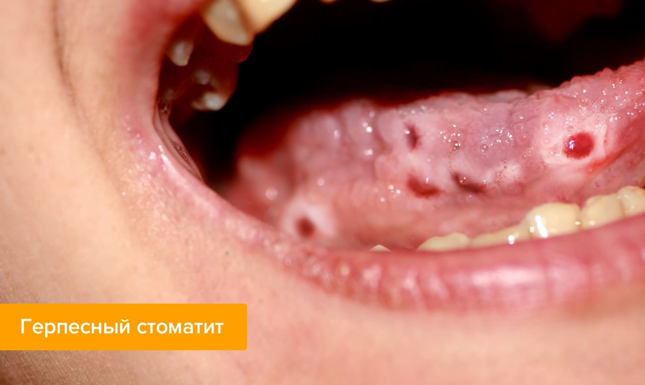 Стоматит на губе после герпеса thumbnail