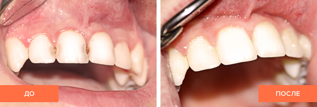 Фото пациента до и после лечения передних зубов