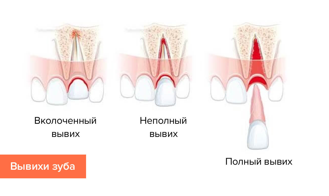 Фото различных вывихов зуба