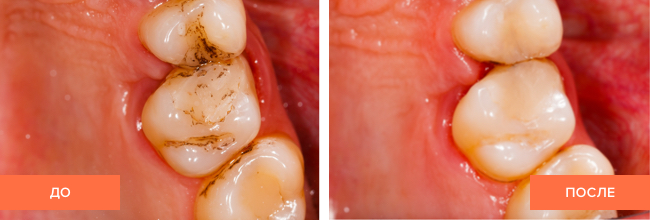 Фото пациента до и после лечения зубов