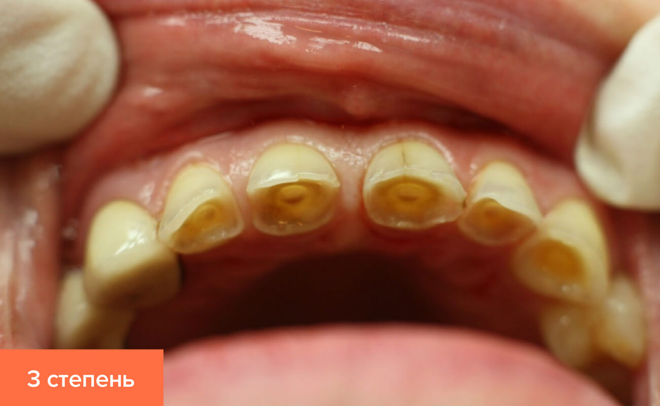 Патологическая стираемость зубов лечение у детей thumbnail