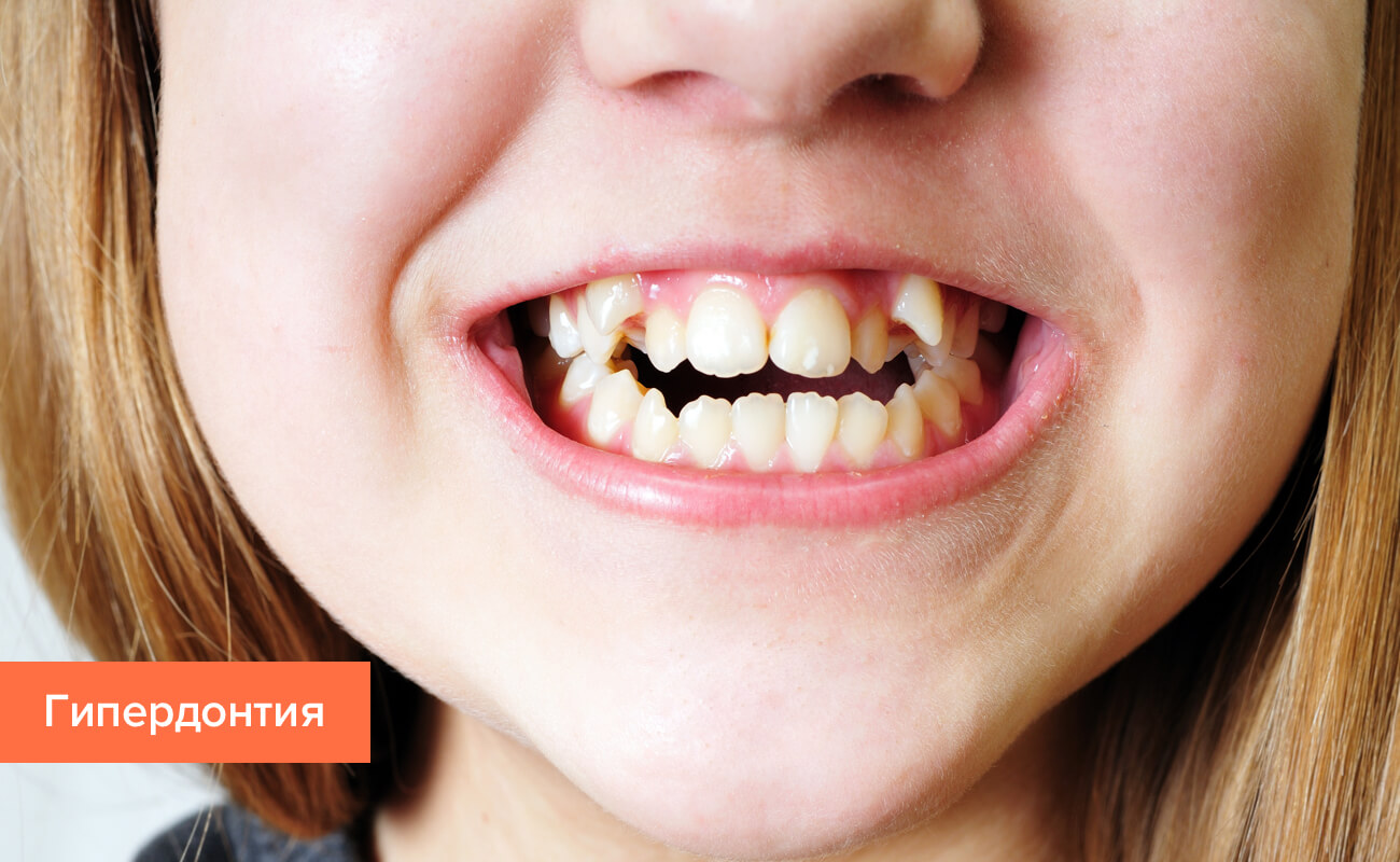 Зубы болезнь зубов связана с организмом thumbnail