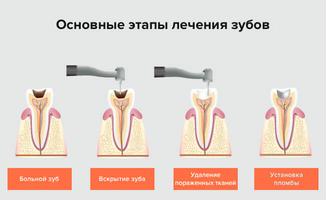 Этапы лечения зубов в картинках