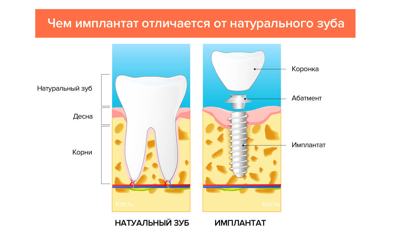 Отличия имплантата от натурального зуба в картинках 