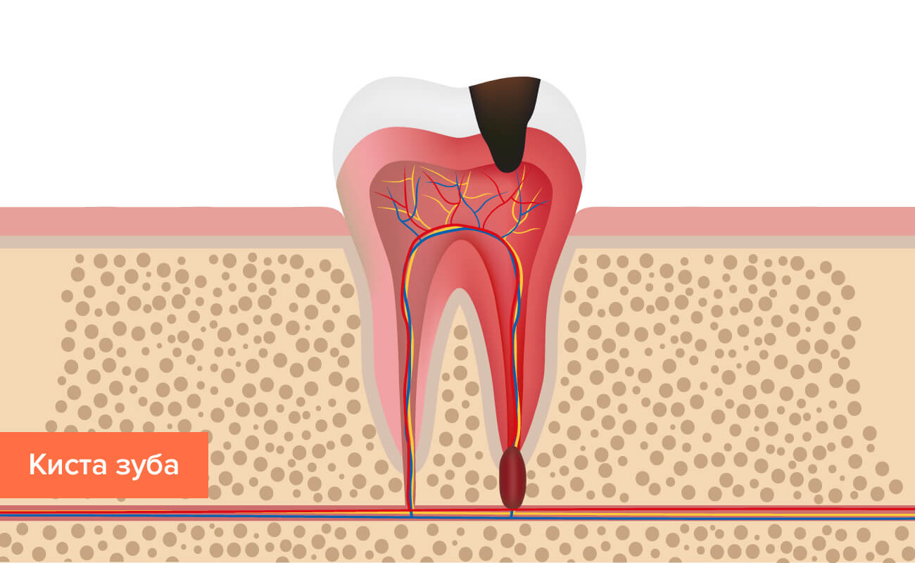 Болезнь зуба зубы за зубами лечение thumbnail