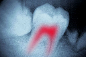 Открыт канал зуба лечение thumbnail