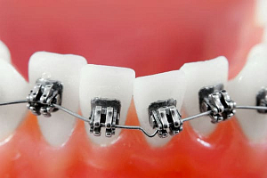 Прикус зубов лечение в thumbnail